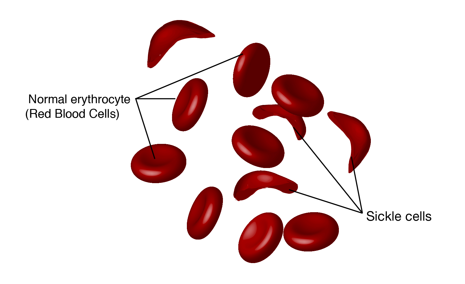 case study sickle cell disease